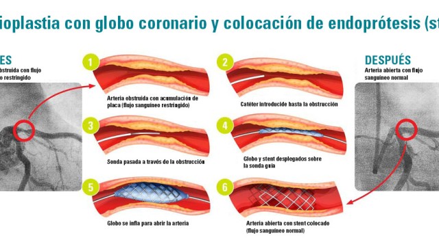 Diagram of a heart blockage