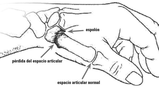 Diagram of a hand, particularly the thumb joints