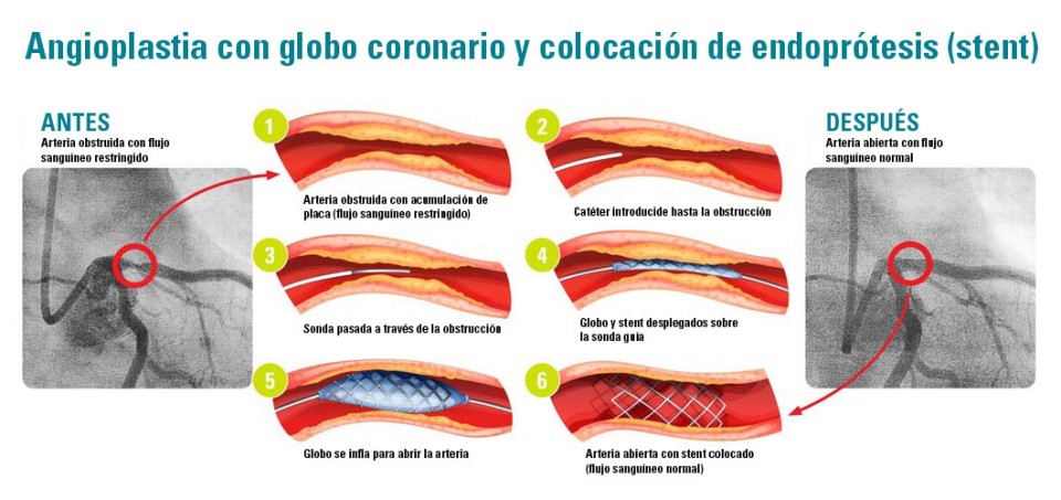 Diagram of a heart blockage