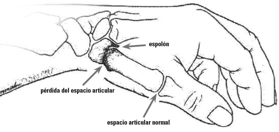 Diagram of a hand, particularly the thumb joints